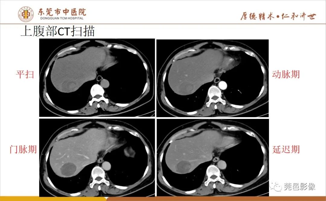 影像PPT - 【病例】肝脏非典型血管瘤1例CT及MR-12