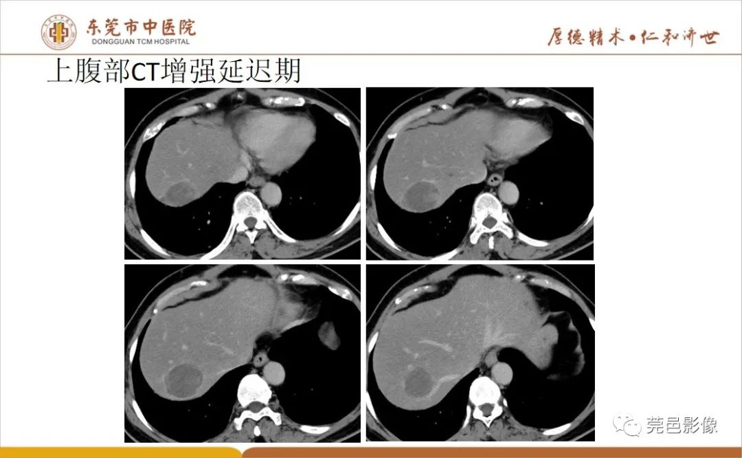 影像PPT - 【病例】肝脏非典型血管瘤1例CT及MR-11