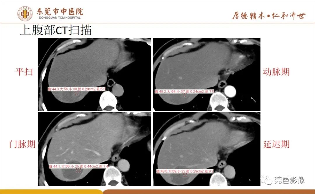 影像PPT - 【病例】肝脏非典型血管瘤1例CT及MR-13