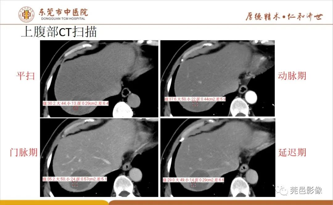 影像PPT - 【病例】肝脏非典型血管瘤1例CT及MR-14