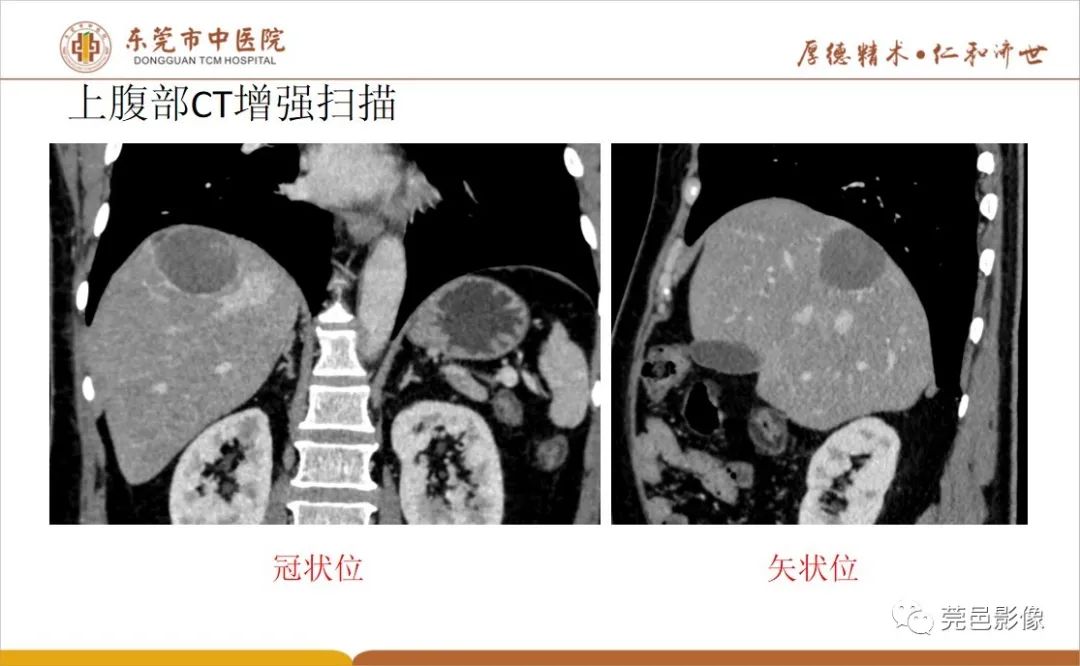 影像PPT - 【病例】肝脏非典型血管瘤1例CT及MR-15