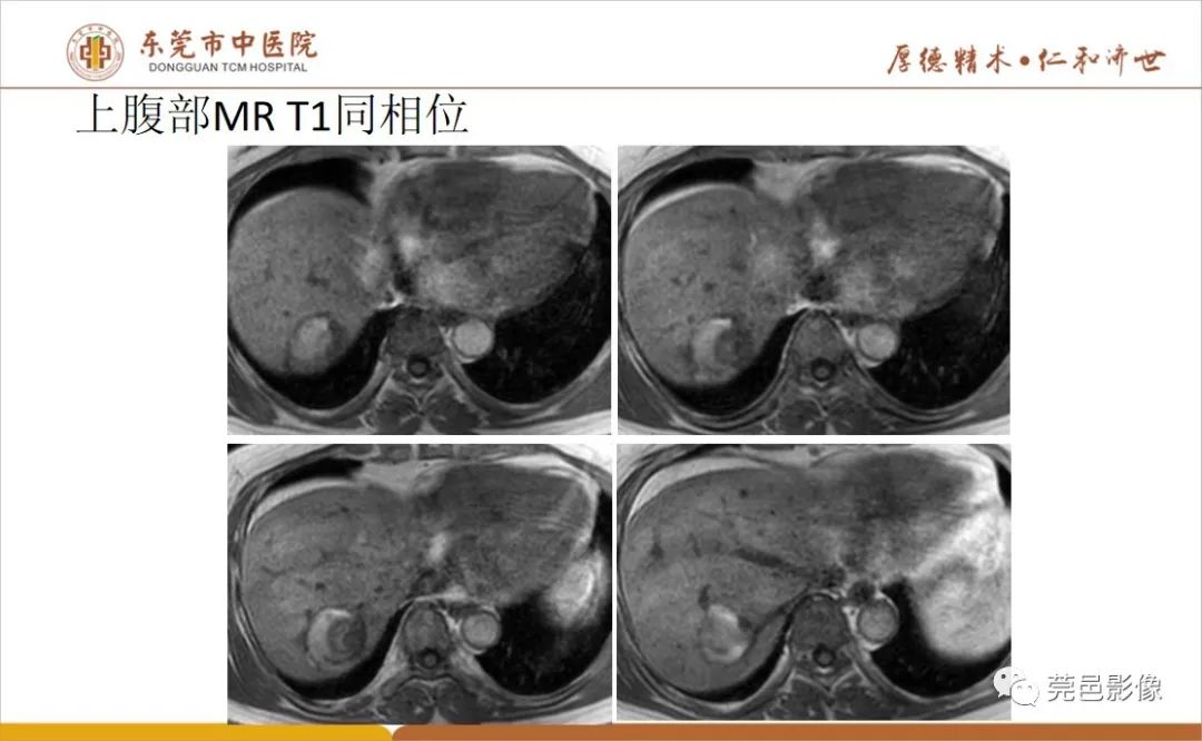 影像PPT - 【病例】肝脏非典型血管瘤1例CT及MR-16