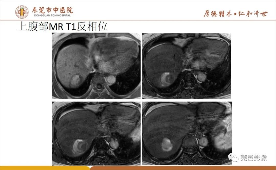 影像PPT - 【病例】肝脏非典型血管瘤1例CT及MR-17