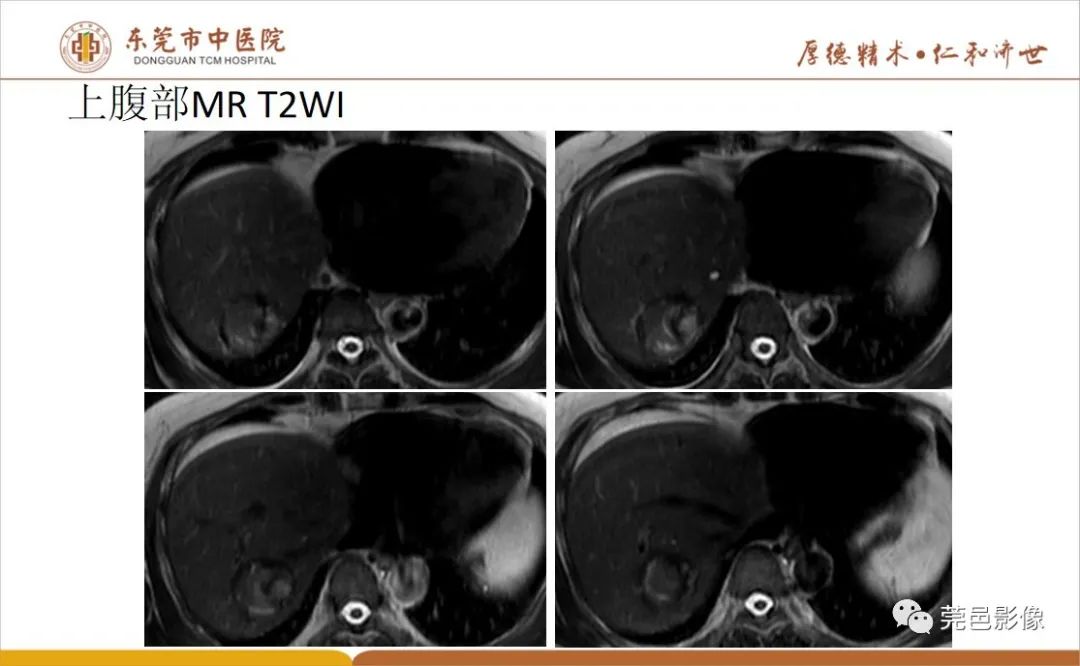 影像PPT - 【病例】肝脏非典型血管瘤1例CT及MR-18