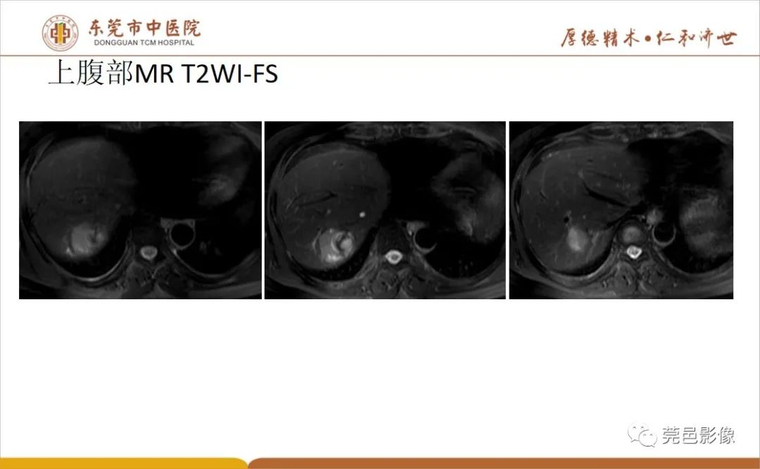 影像PPT - 【病例】肝脏非典型血管瘤1例CT及MR-19