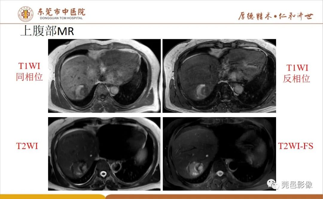 影像PPT - 【病例】肝脏非典型血管瘤1例CT及MR-20