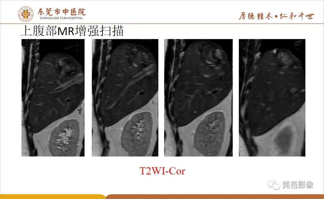 影像PPT - 【病例】肝脏非典型血管瘤1例CT及MR-21