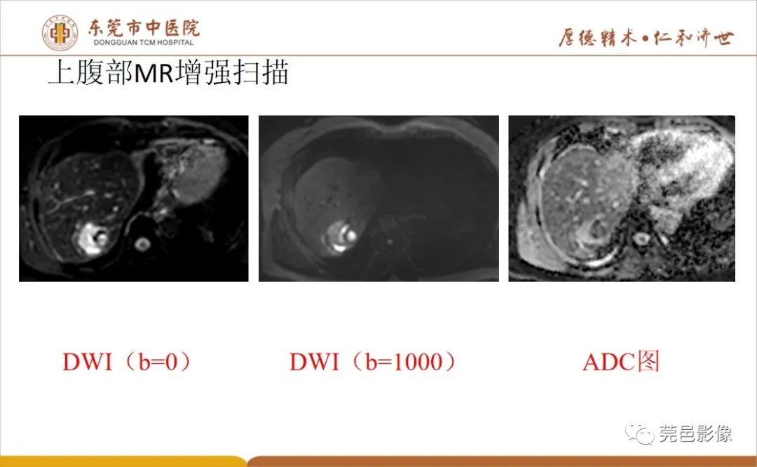 影像PPT - 【病例】肝脏非典型血管瘤1例CT及MR-22