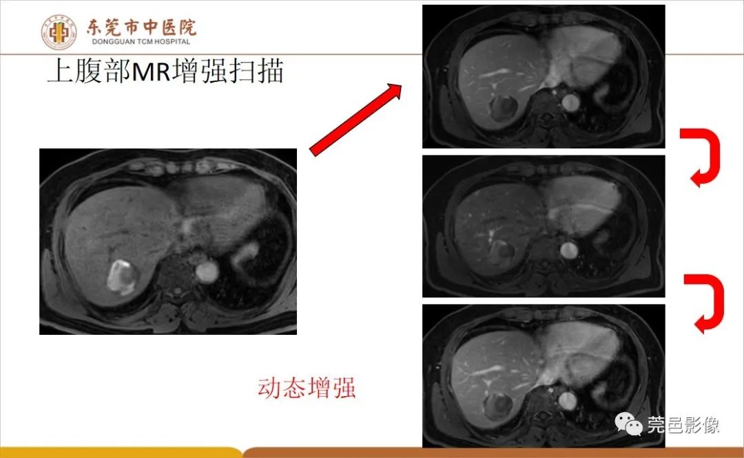 影像PPT - 【病例】肝脏非典型血管瘤1例CT及MR-23