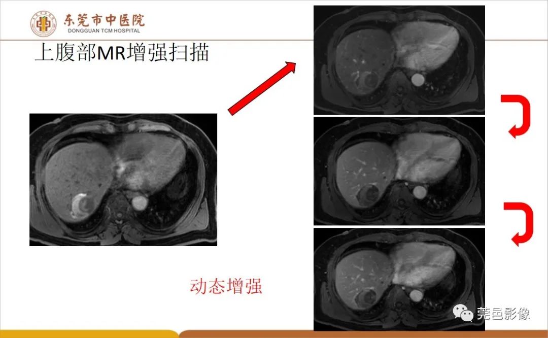 影像PPT - 【病例】肝脏非典型血管瘤1例CT及MR-24