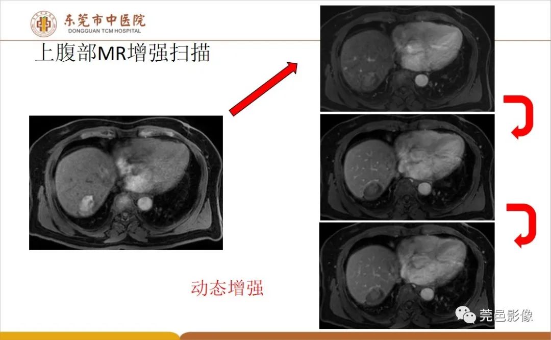 影像PPT - 【病例】肝脏非典型血管瘤1例CT及MR-25