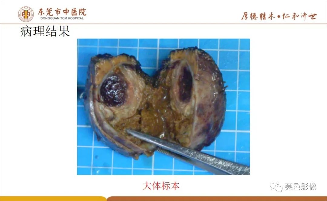 影像PPT - 【病例】肝脏非典型血管瘤1例CT及MR-32