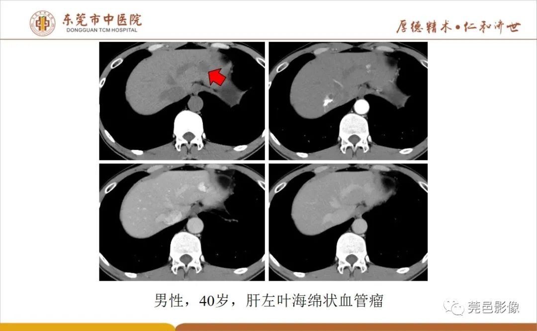 影像PPT - 【病例】肝脏非典型血管瘤1例CT及MR-38