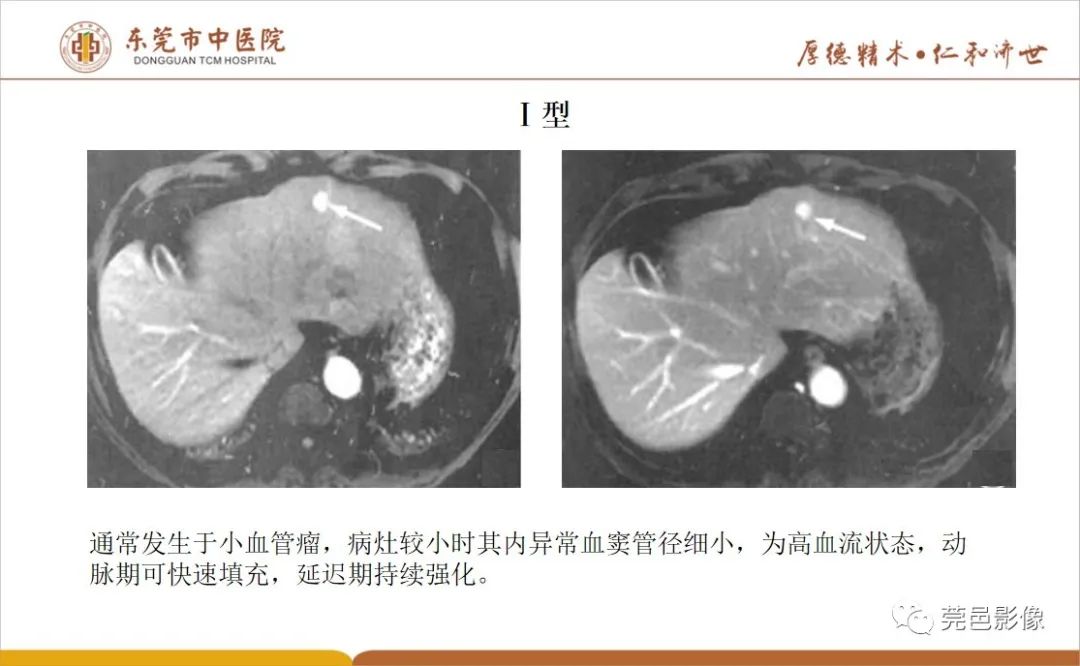 影像PPT - 【病例】肝脏非典型血管瘤1例CT及MR-40