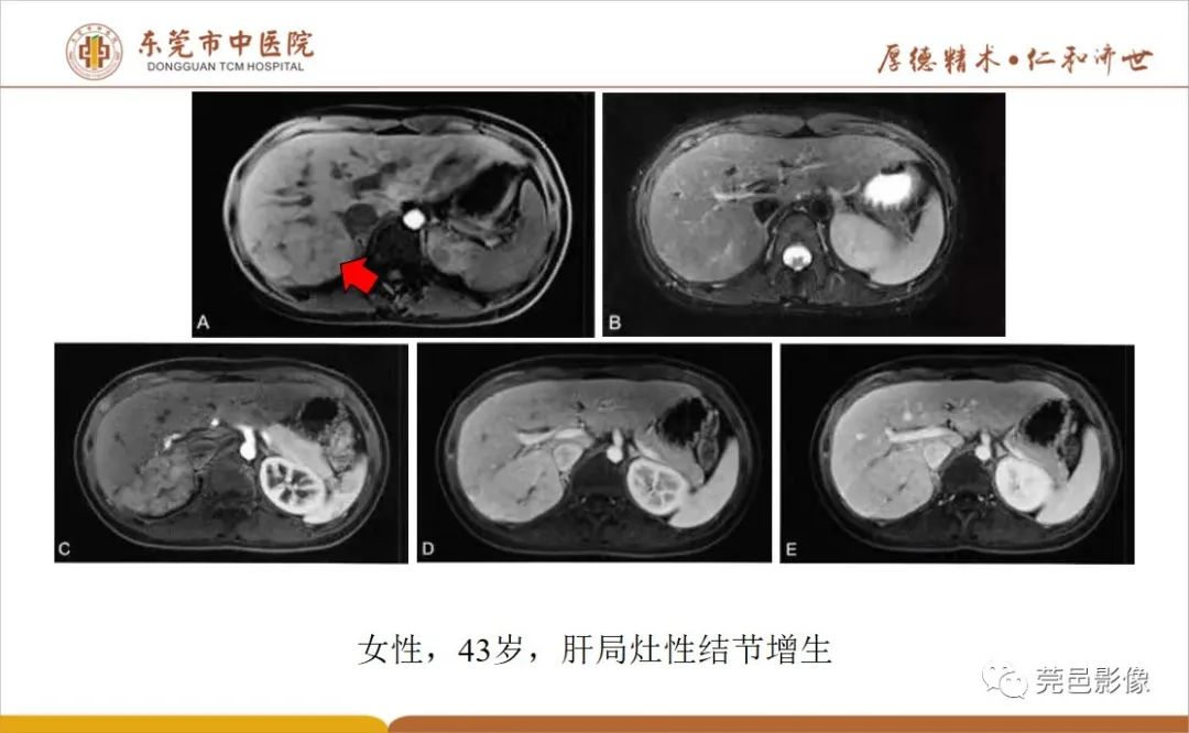 影像PPT - 【病例】肝脏非典型血管瘤1例CT及MR-42