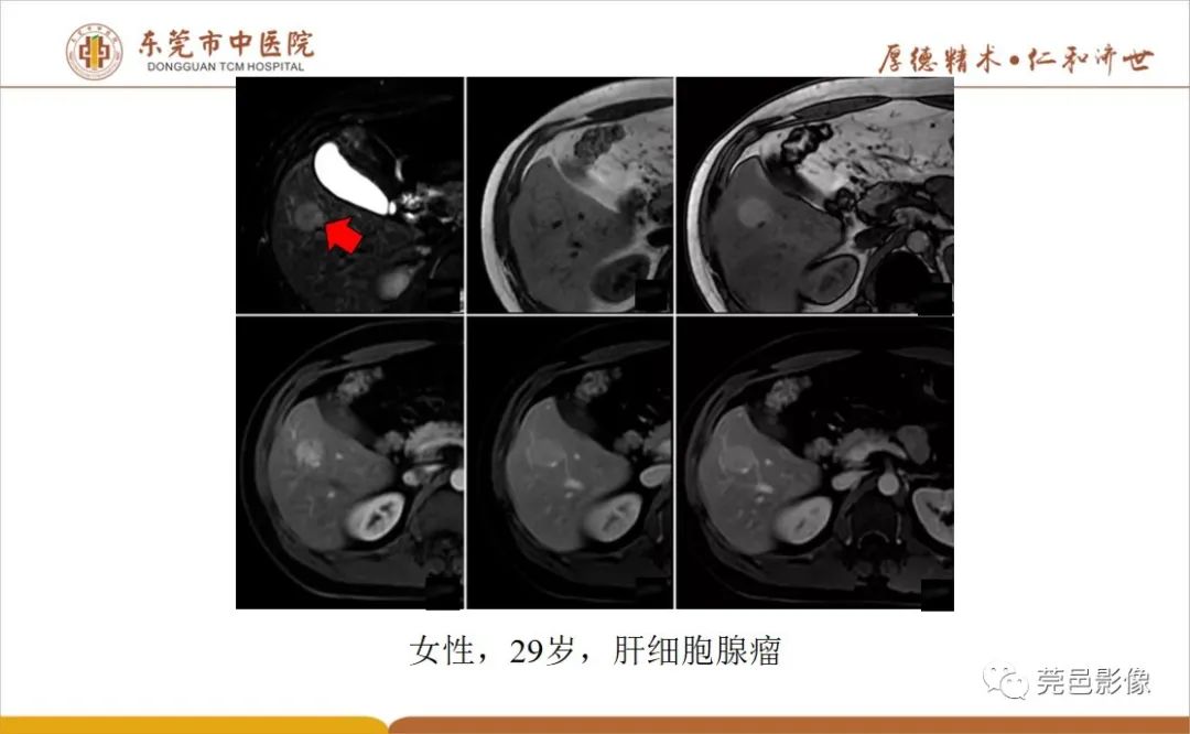 影像PPT - 【病例】肝脏非典型血管瘤1例CT及MR-43