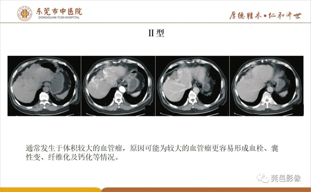 影像PPT - 【病例】肝脏非典型血管瘤1例CT及MR-44