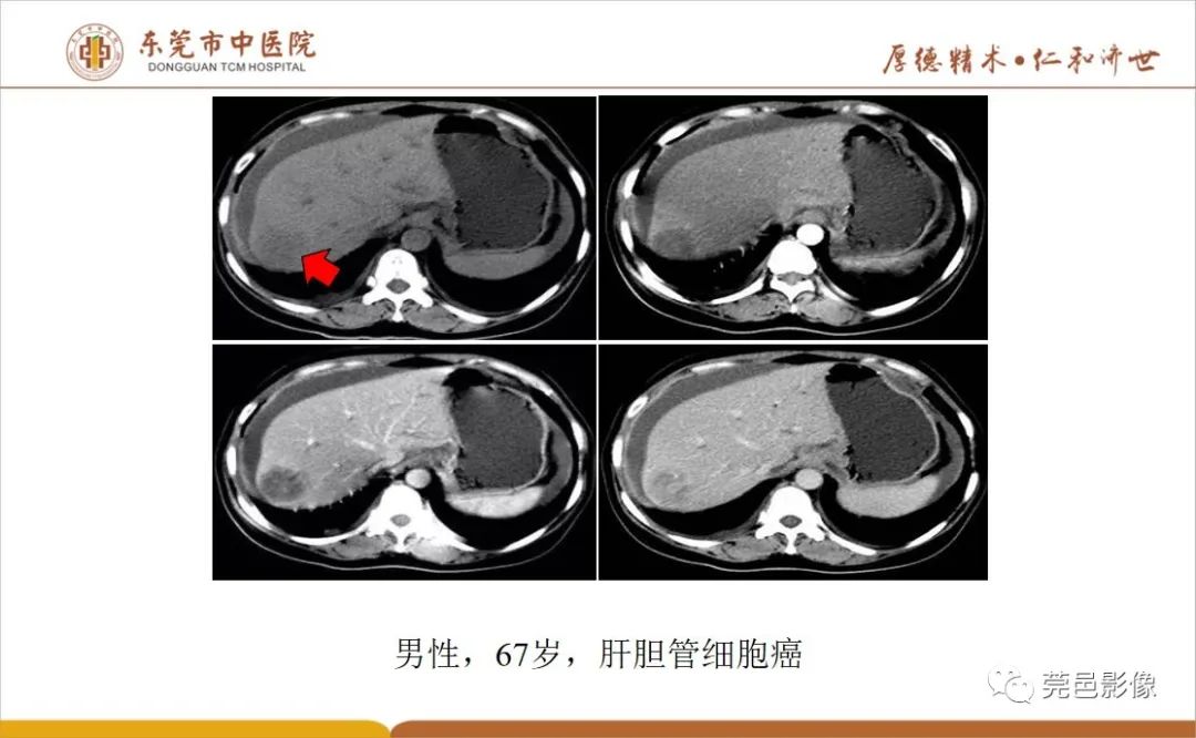 影像PPT - 【病例】肝脏非典型血管瘤1例CT及MR-46