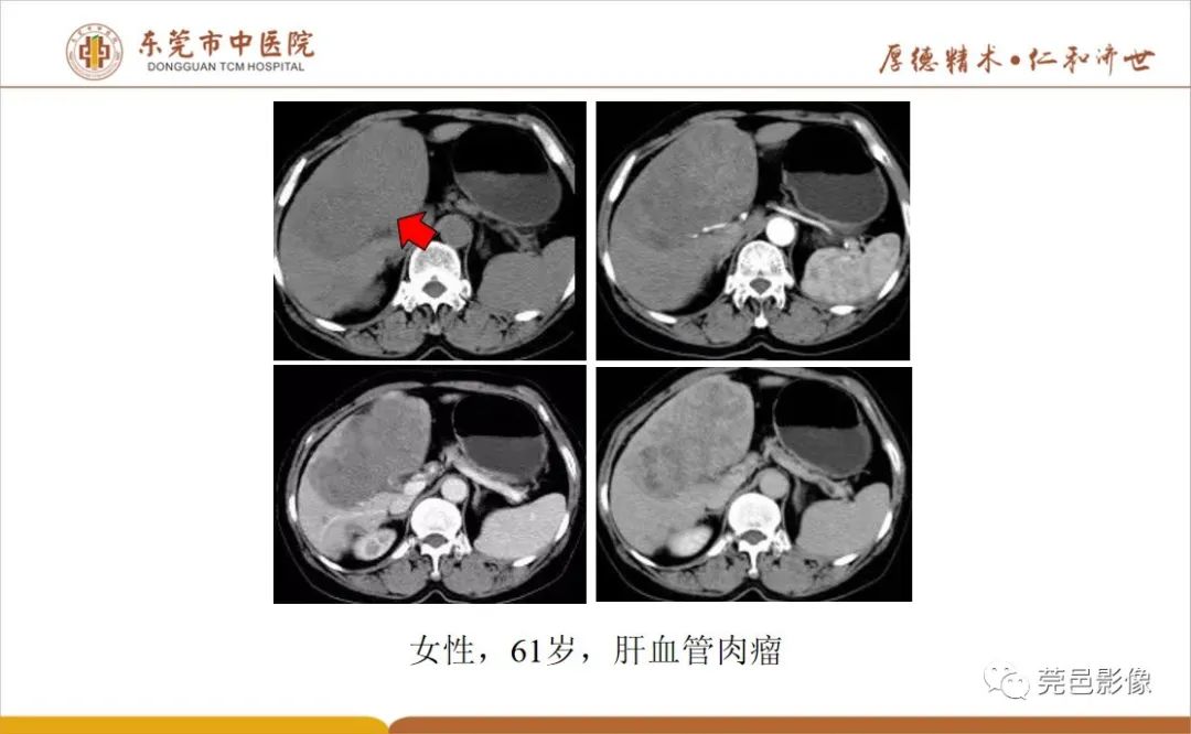 影像PPT - 【病例】肝脏非典型血管瘤1例CT及MR-47
