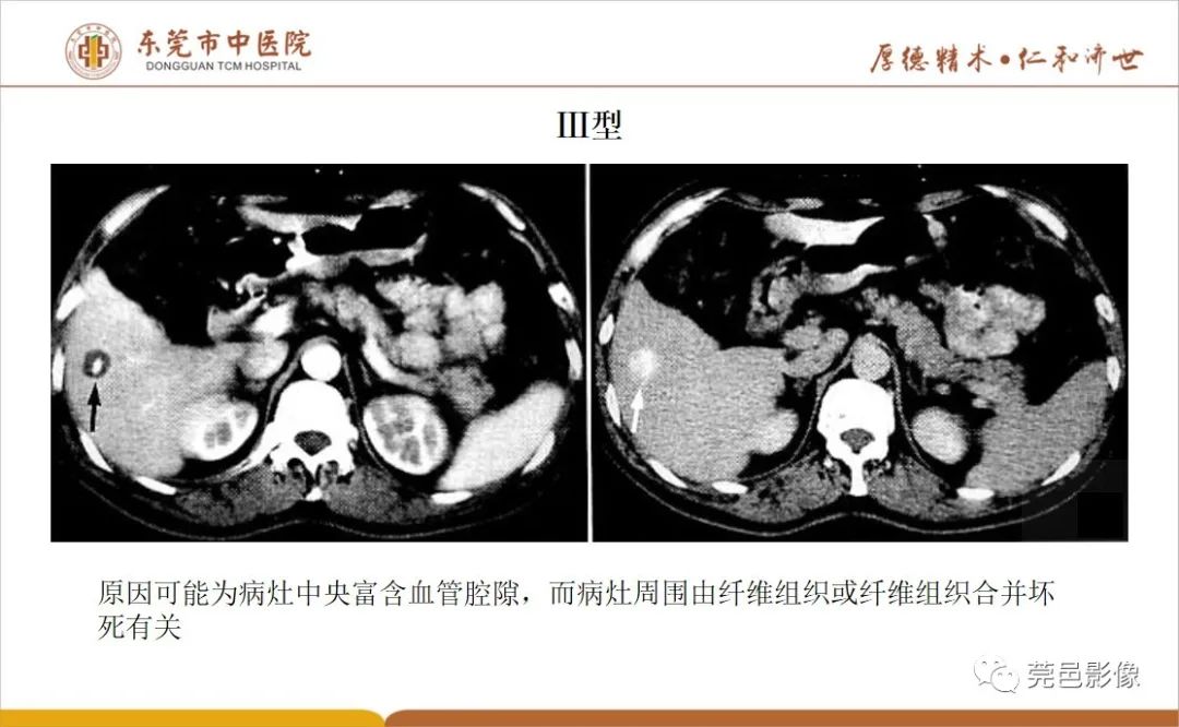 影像PPT - 【病例】肝脏非典型血管瘤1例CT及MR-48
