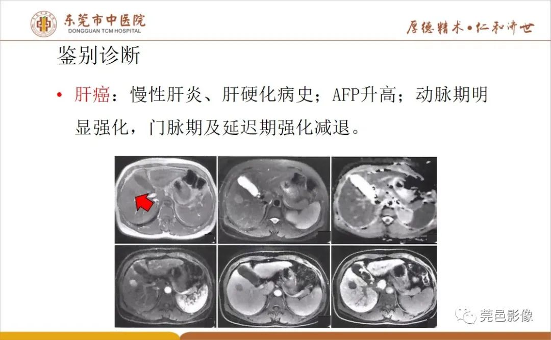 影像PPT - 【病例】肝脏非典型血管瘤1例CT及MR-49