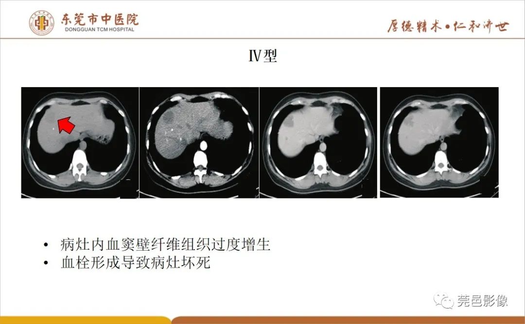 影像PPT - 【病例】肝脏非典型血管瘤1例CT及MR-50