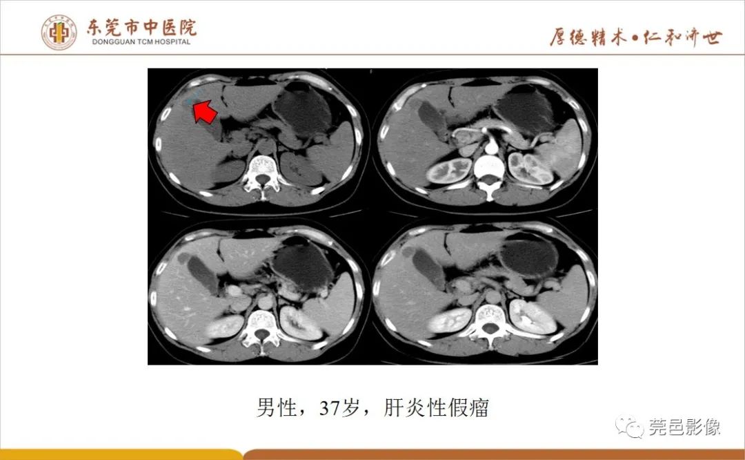 影像PPT - 【病例】肝脏非典型血管瘤1例CT及MR-52