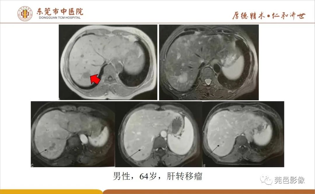 影像PPT - 【病例】肝脏非典型血管瘤1例CT及MR-53