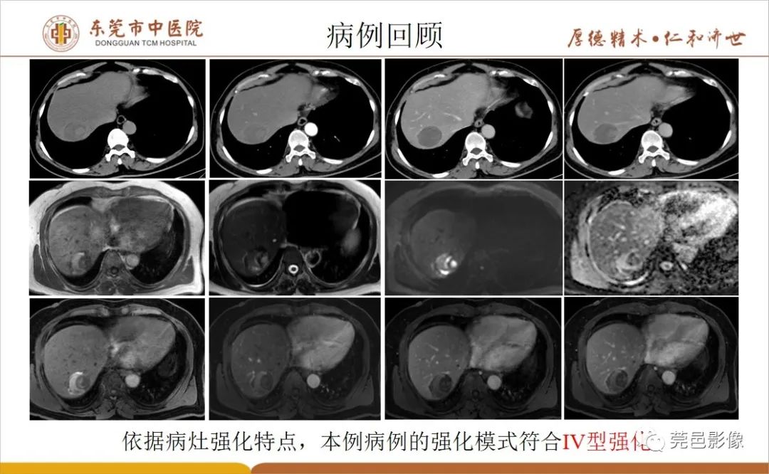 影像PPT - 【病例】肝脏非典型血管瘤1例CT及MR-54