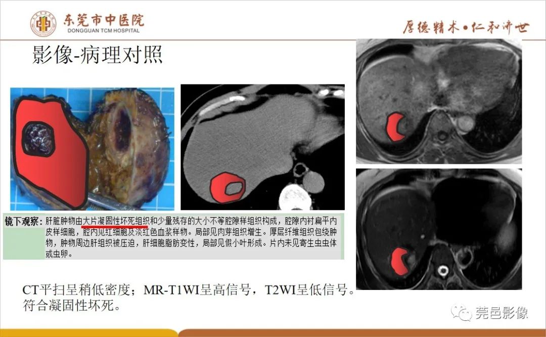 影像PPT - 【病例】肝脏非典型血管瘤1例CT及MR-55