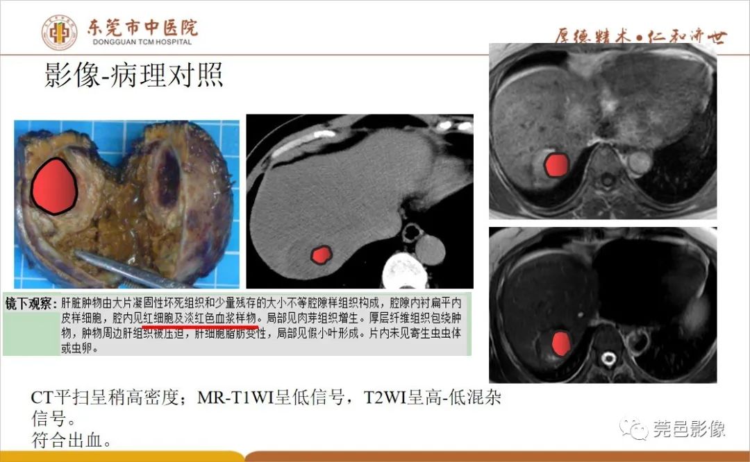 影像PPT - 【病例】肝脏非典型血管瘤1例CT及MR-56
