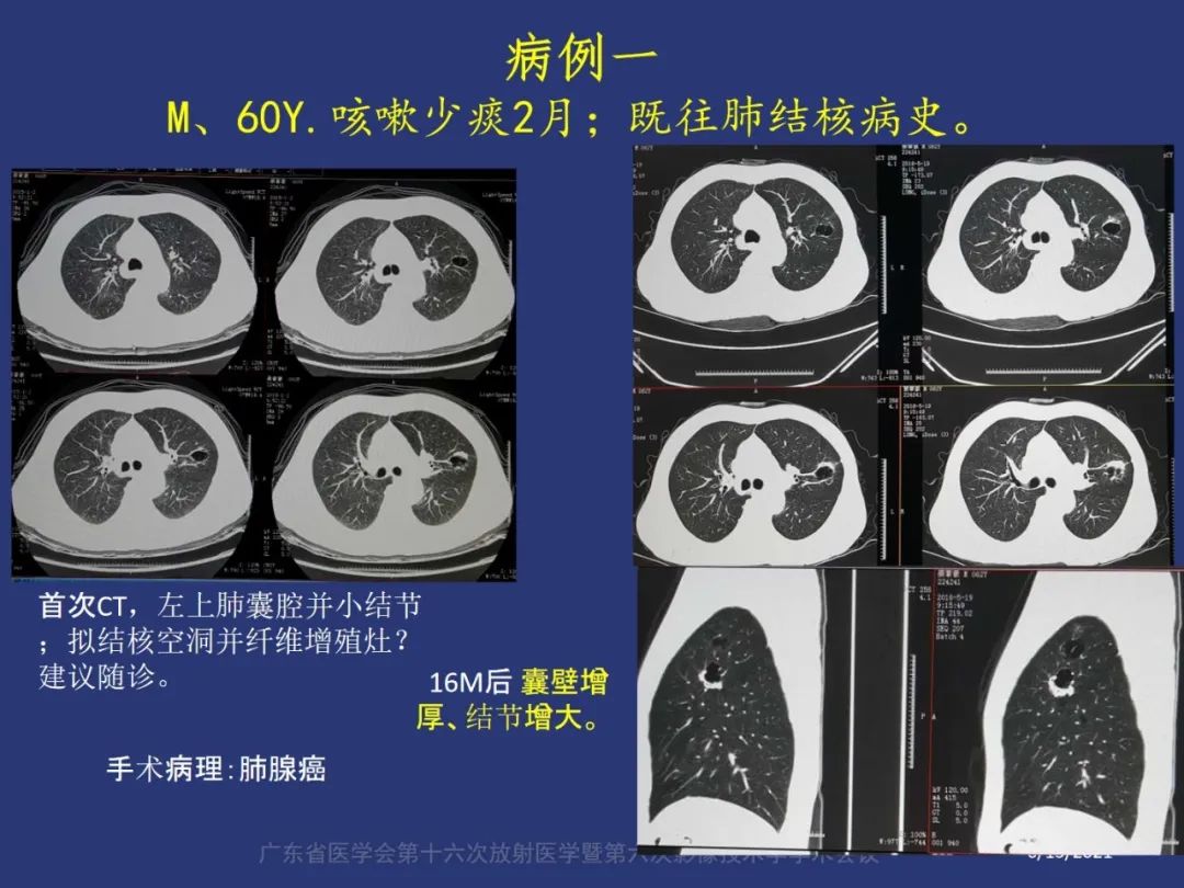 影像PPT - 【PPT】囊腔性肺癌的影像特征和鉴别诊断-2