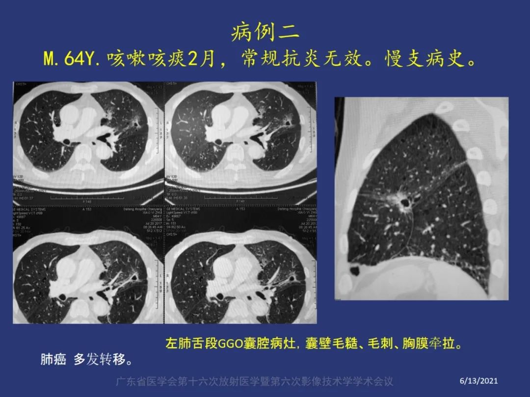 影像PPT - 【PPT】囊腔性肺癌的影像特征和鉴别诊断-3