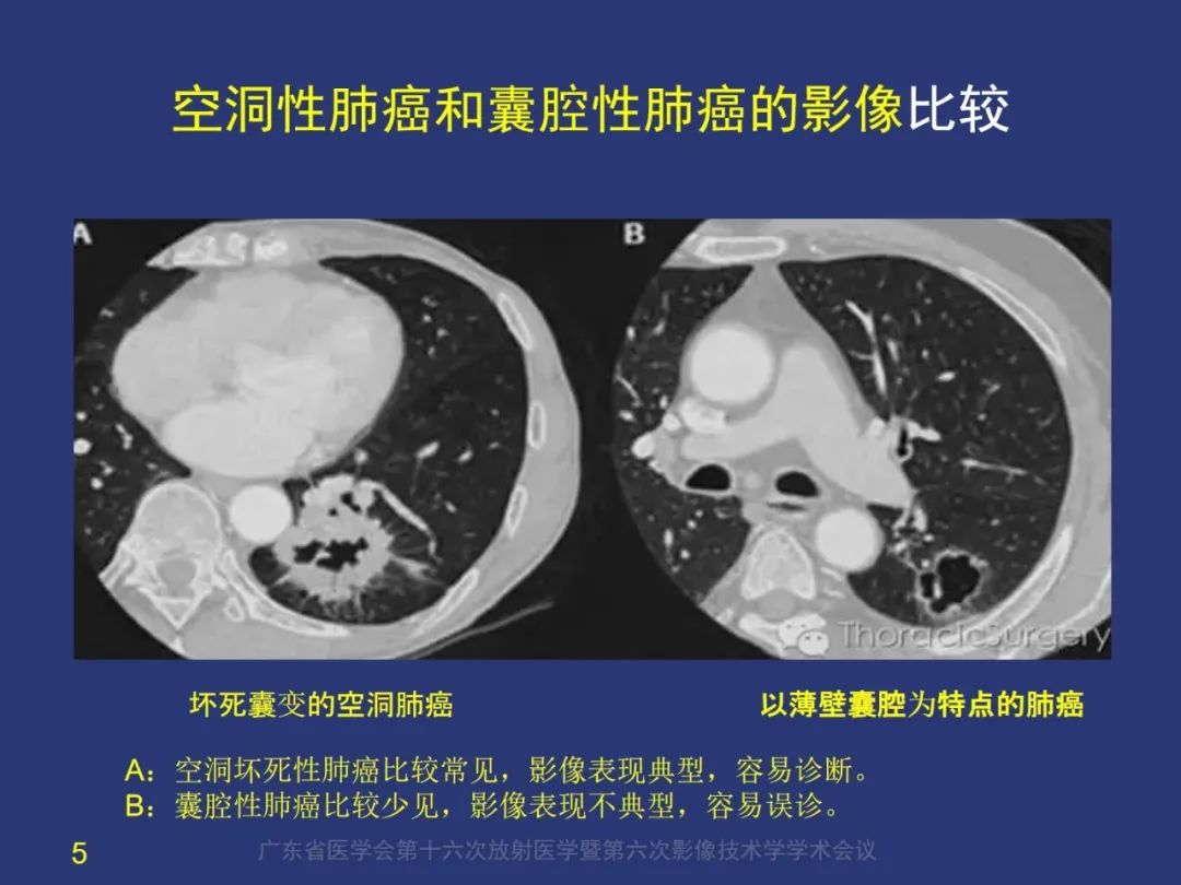 影像PPT - 【PPT】囊腔性肺癌的影像特征和鉴别诊断-5