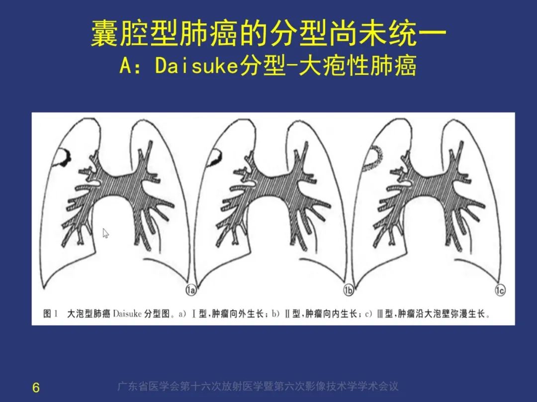 影像PPT - 【PPT】囊腔性肺癌的影像特征和鉴别诊断-6