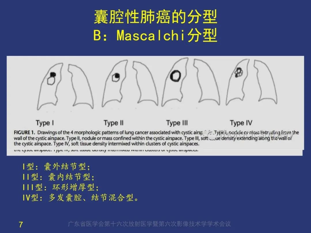 影像PPT - 【PPT】囊腔性肺癌的影像特征和鉴别诊断-7