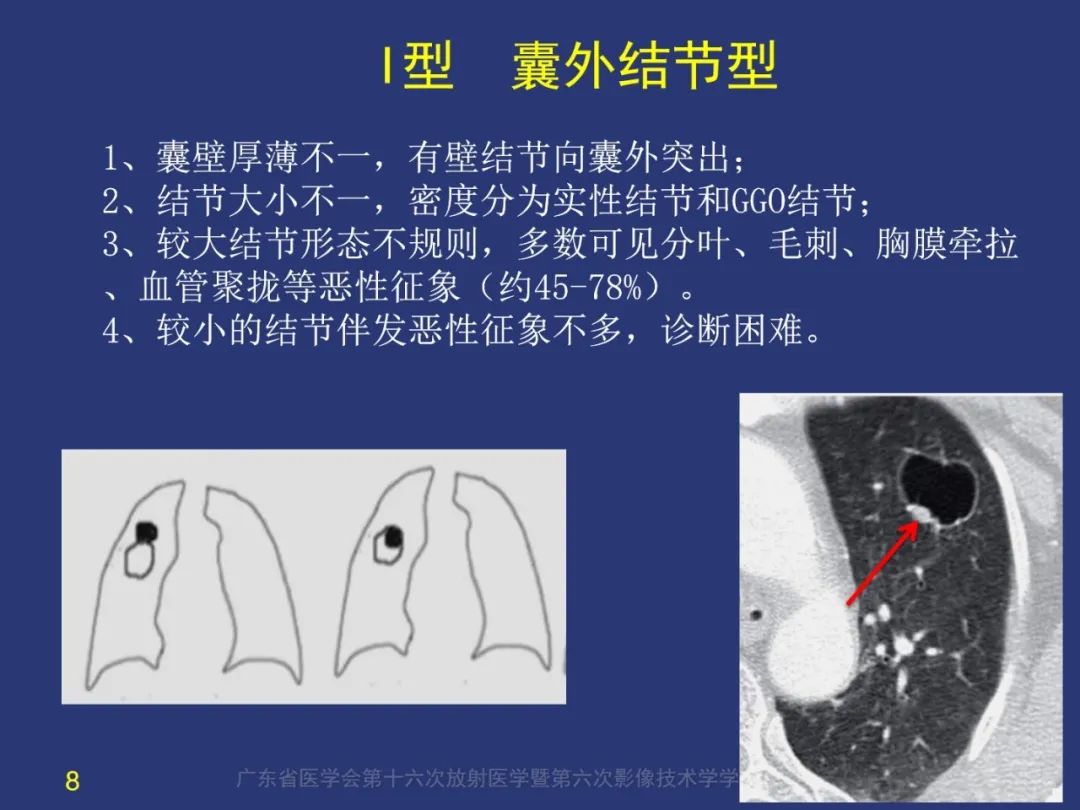 影像PPT - 【PPT】囊腔性肺癌的影像特征和鉴别诊断-8