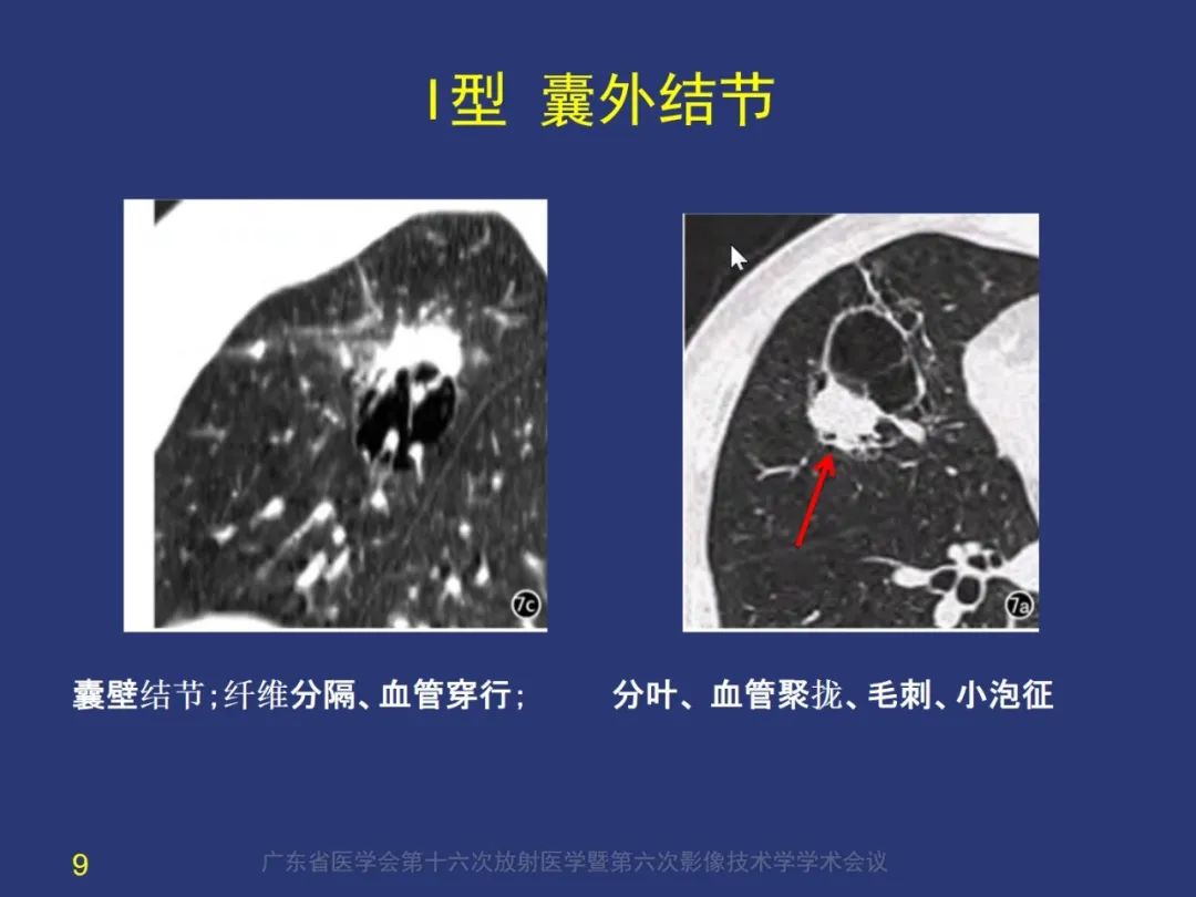 影像PPT - 【PPT】囊腔性肺癌的影像特征和鉴别诊断-9