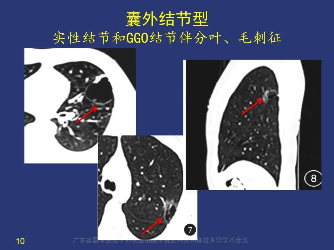 影像PPT - 【PPT】囊腔性肺癌的影像特征和鉴别诊断-10