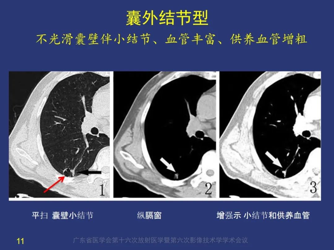 影像PPT - 【PPT】囊腔性肺癌的影像特征和鉴别诊断-11