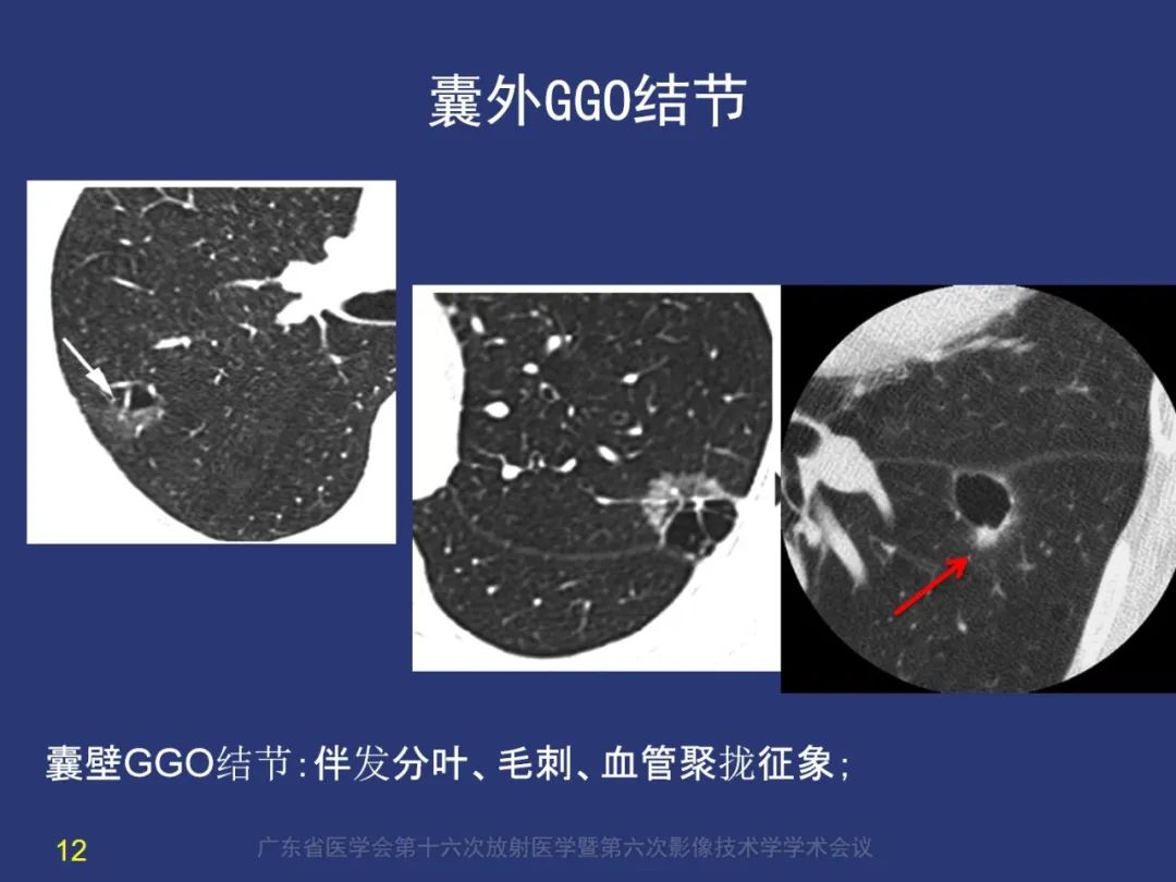 影像PPT - 【PPT】囊腔性肺癌的影像特征和鉴别诊断-12