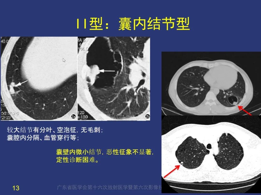 影像PPT - 【PPT】囊腔性肺癌的影像特征和鉴别诊断-13