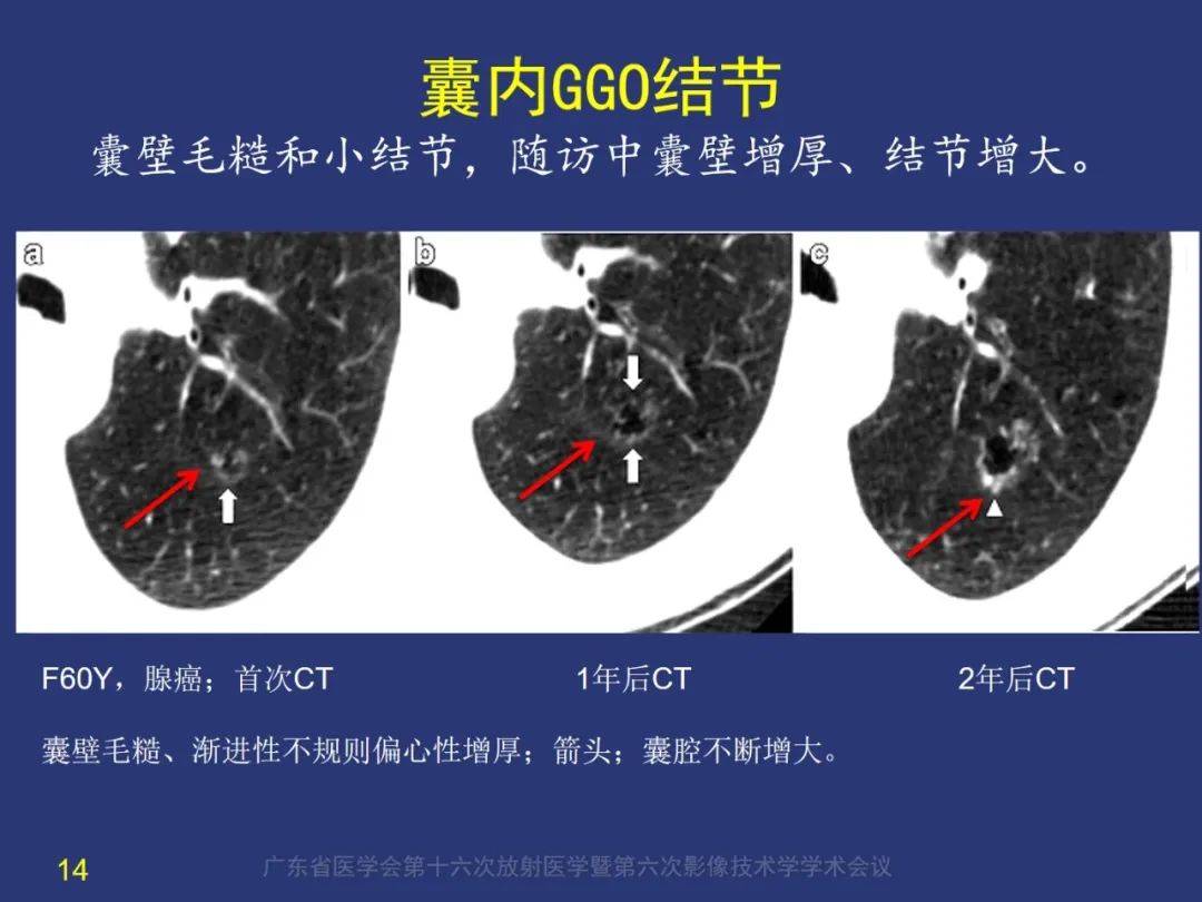 影像PPT - 【PPT】囊腔性肺癌的影像特征和鉴别诊断-14