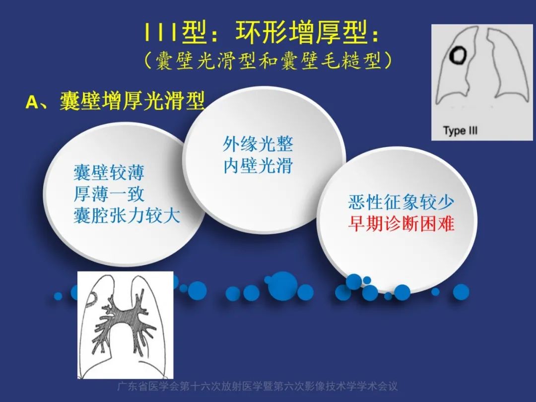 影像PPT - 【PPT】囊腔性肺癌的影像特征和鉴别诊断-15