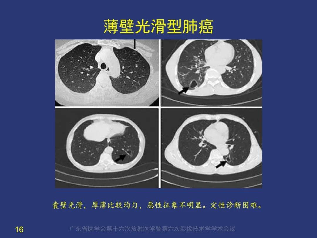 影像PPT - 【PPT】囊腔性肺癌的影像特征和鉴别诊断-16