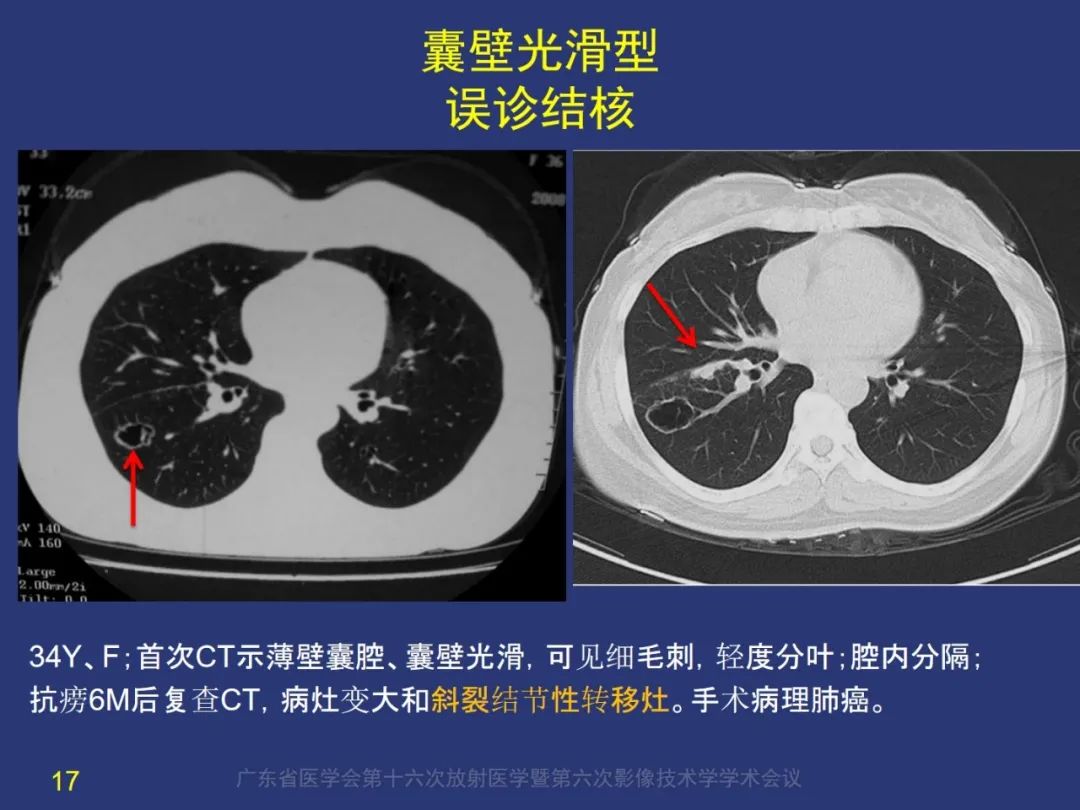 影像PPT - 【PPT】囊腔性肺癌的影像特征和鉴别诊断-17