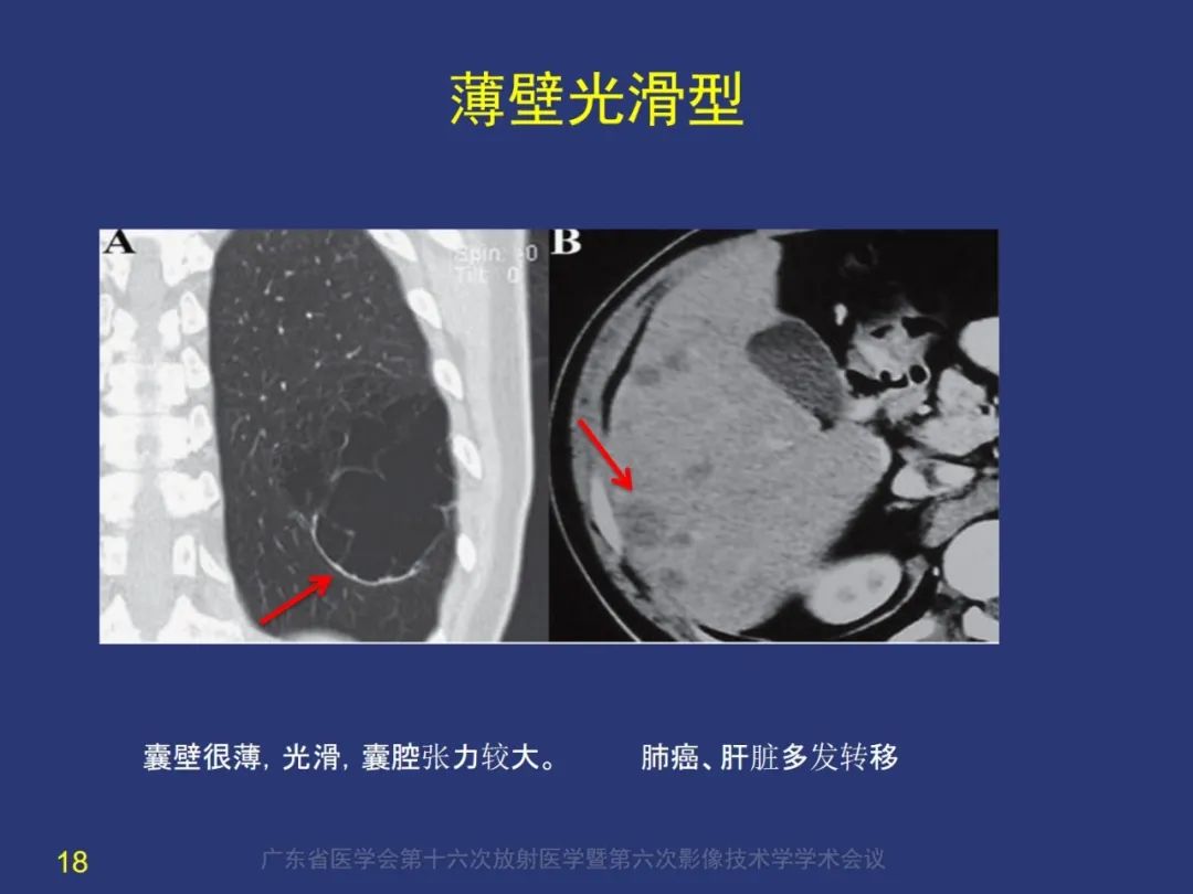 影像PPT - 【PPT】囊腔性肺癌的影像特征和鉴别诊断-18
