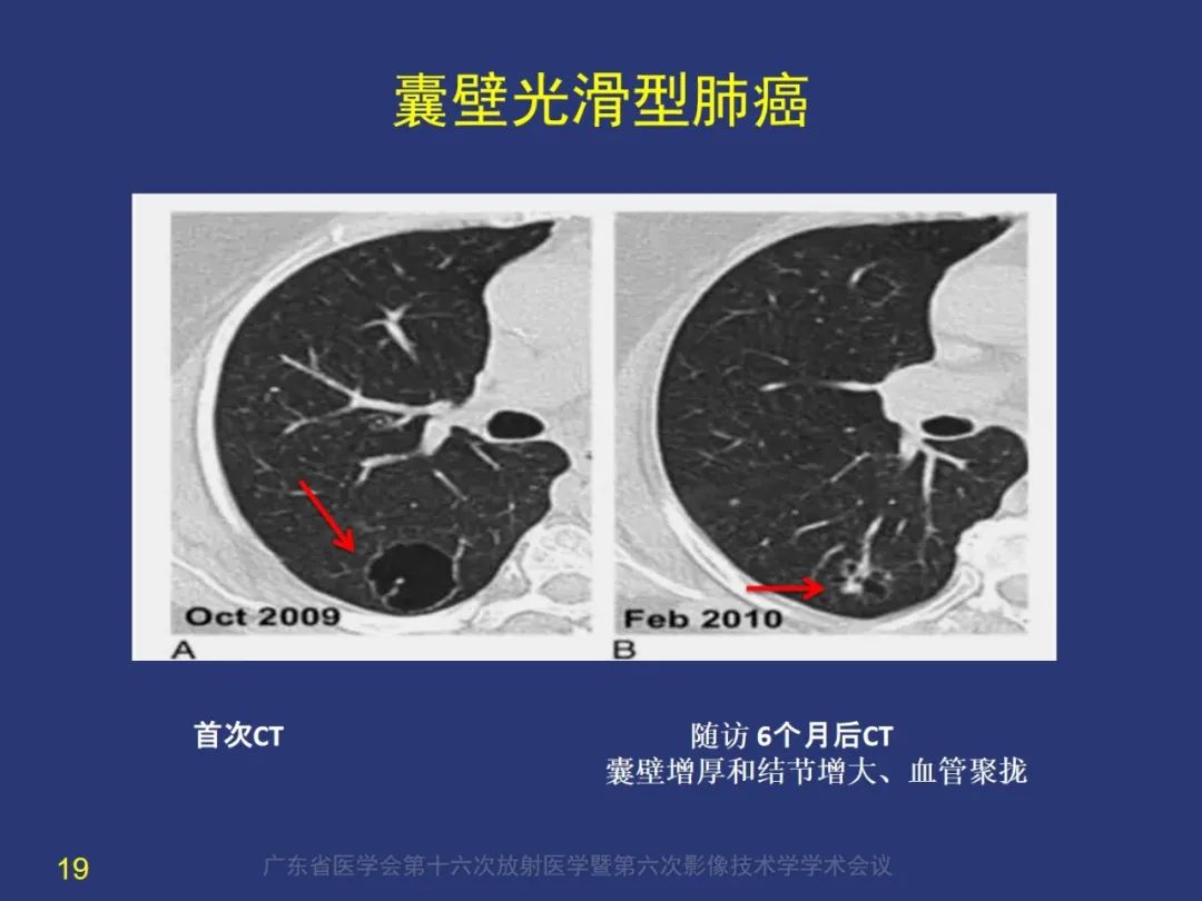 影像PPT - 【PPT】囊腔性肺癌的影像特征和鉴别诊断-19