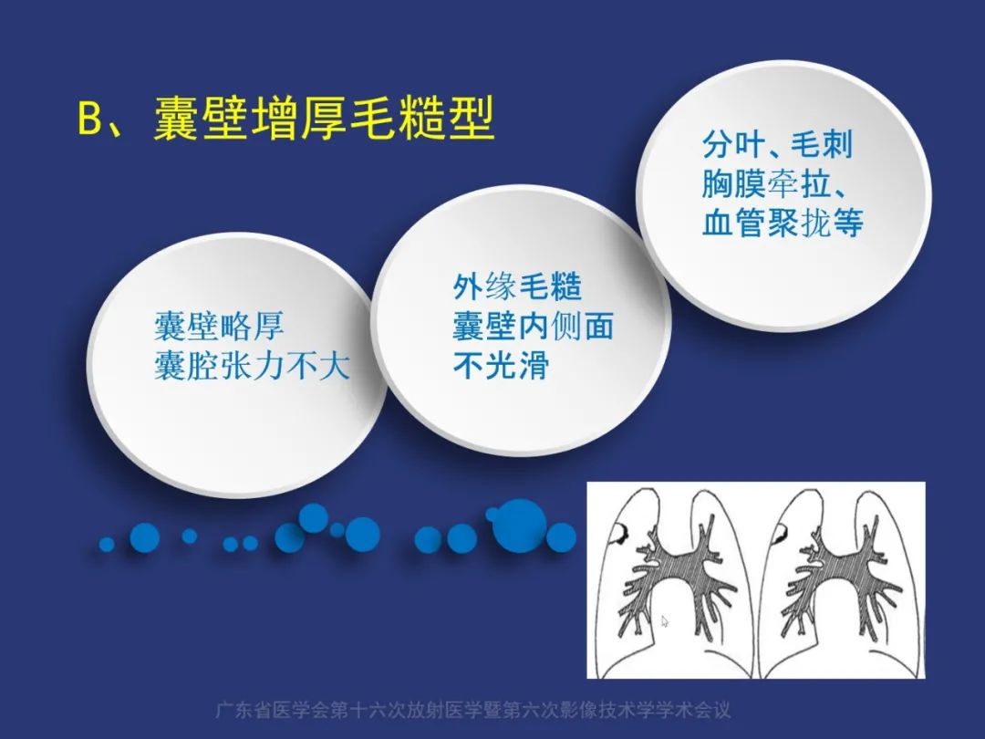 影像PPT - 【PPT】囊腔性肺癌的影像特征和鉴别诊断-20