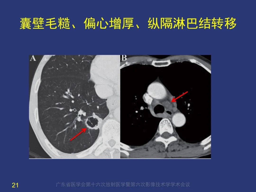 影像PPT - 【PPT】囊腔性肺癌的影像特征和鉴别诊断-21